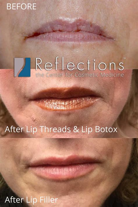 Upper Lip Botox Before And After