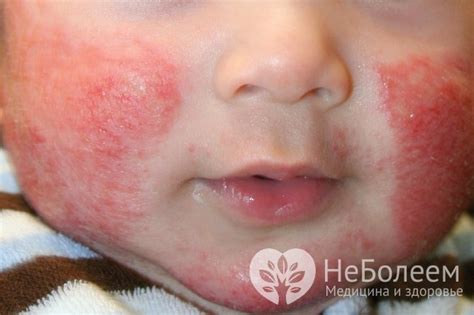 Диатез – симптомы, лечение, диатез на щеках и лице у взрослых, причины