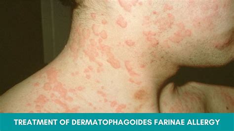 How to Treat Dermatophagoides Farinae Allergy Naturally?
