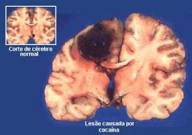 O Que A Cocaina Faz No Cerebro - COCAINA EFECTOS EN EL SISTEMA NERVIOSO ️ Mentalidad Humana