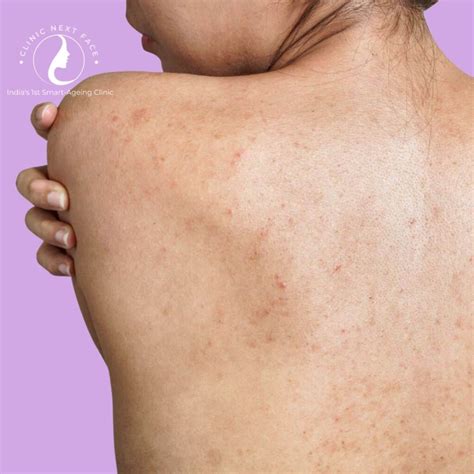 acne treatment  bangalore clinic  face
