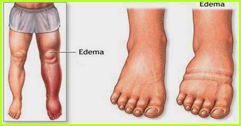 Edema and Its Types - Overall Science