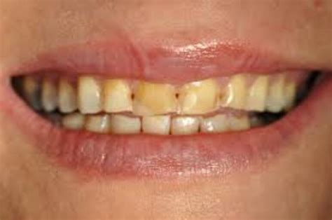 Enlarged taste buds and burned tongue feeling