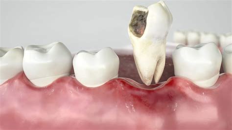 Tooth Extraction Done The Easy Way | Houston Dentists | FMS Dental