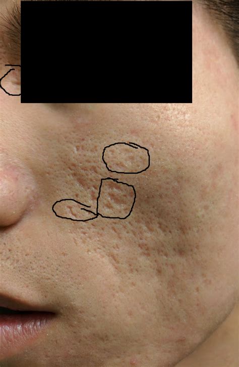 Review of the phenol peel (1+ year later) – Scar treatments – Acne.org ...
