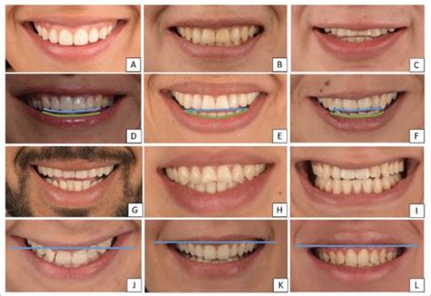 Classification of smile line, smile arc, smile types, and upper lip ...