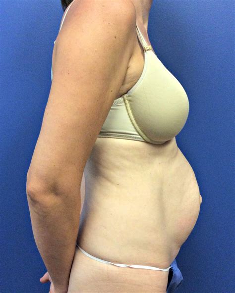The... - The Plastic Surgery Center / Tzvi Small, MD, FACS