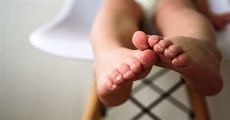 Psoriasis in children: Symptoms, treatments, and causes