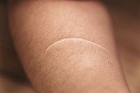 What Are the Causes of Keloid Scars?