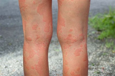 Coceira E Vermelhidão Na Pele - Alergia na pele com coceira? Entenda as causas e como tratar