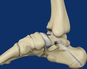 Subtalar Fusion Cockeysville, Towson | Subtalar Arthrodesis Towson ...