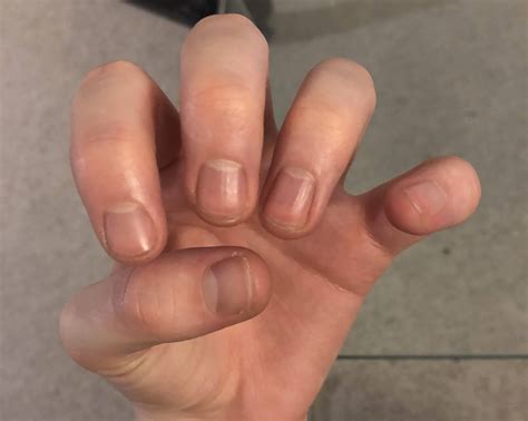 guitar - Finger dexterity issues - Music: Practice & Theory Stack Exchange