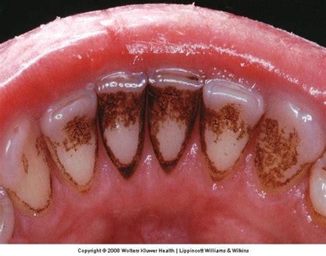 Dental Materials Polishing & Abrasion Flashcards | Quizlet