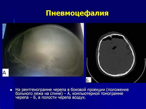 Лучевая диагностика черепно-мозговых травм и травм позвоночника ...