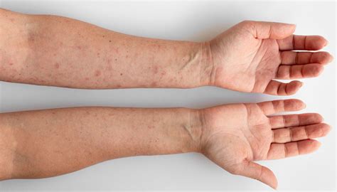 Shingles - My Nutrition Rx