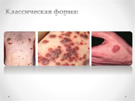 Саркома Капоши - презентация онлайн