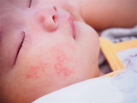 Alergia No Rosto Pós Parto - Bebê recém-nascido com alergia de dermatite no rosto | Foto Premium