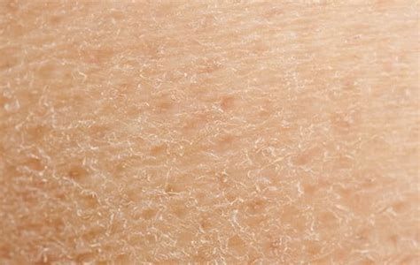 Itchy skin | Eucerin