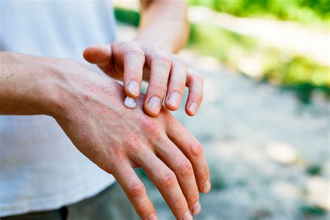 Dermatitis atòpica i protecció solar - Farmaceuticonline