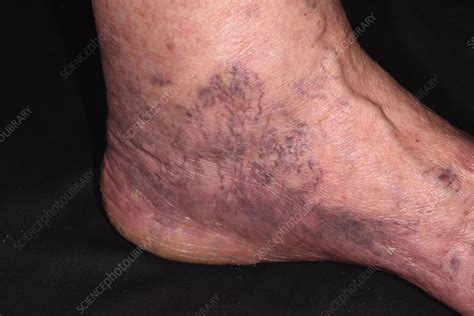 Peripheral vascular disease - Stock Image - C054/9385 - Science Photo ...