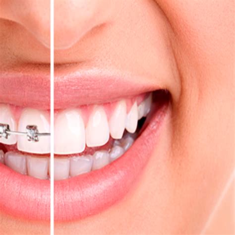 Cores De Aparelho Que Deixa O Dente Mais Branco - Aparelho Branco Para Dentes
