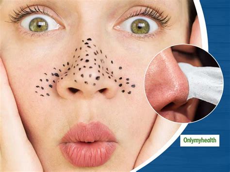 The Future of Skin Care? Unbelievable Blackhead Removal 2024 Explained - vfjnrbw
