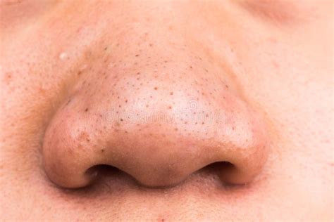 Closed-up Of Pimple Blackheads On The Nose Stock Photo - Image of ...