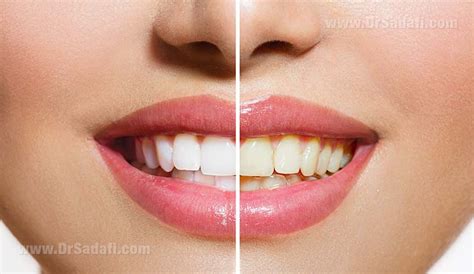 how to bleach teeth at home