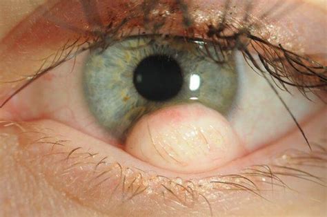 limbal dermoid tribunnewswikicom
