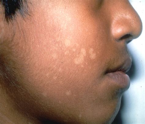 List 99+ Pictures Bacterial Infection On Skin Images Stunning