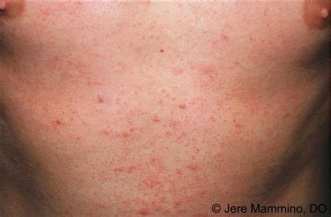 Rash On Neck And Chest Looks Like Pimples | Allergy Trigger