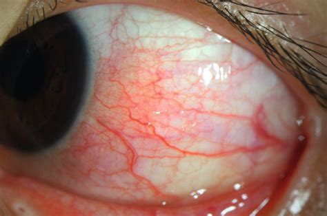 Episcleritis: case report, description and management