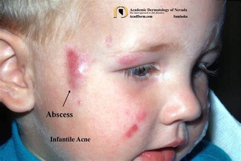 Infantile Acne