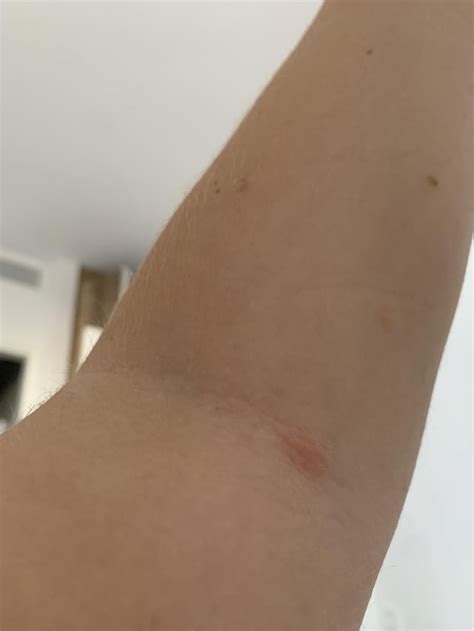Itchy rash : r/DermatologyQuestions