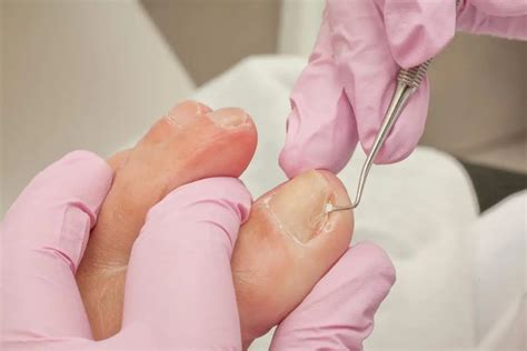 What are the best ways to cut an ingrown toenail?