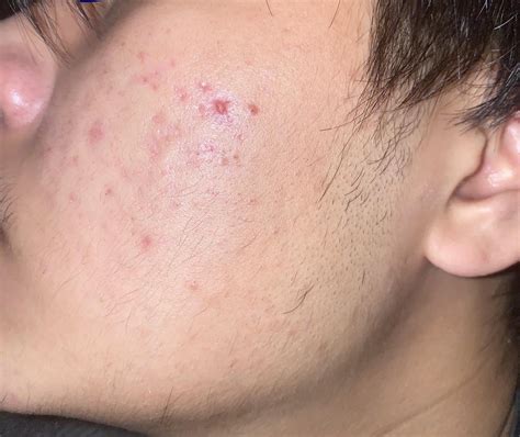 is this acne scarring? if it is is it bad? : r/AcneScars