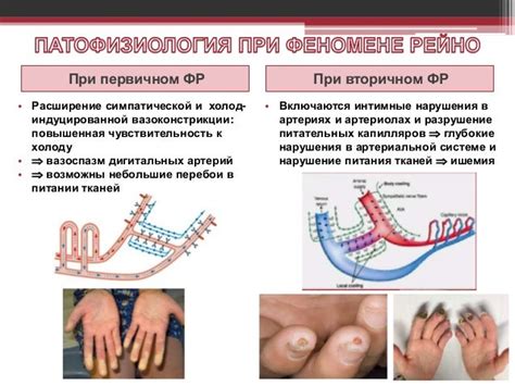 Феномен Рейно в ревматологической практике