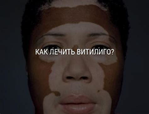 Как лечить витилиго у детей и взрослых: причины и симптомы витилиго