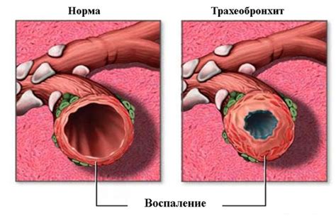 Трахеобронхит - признаки, причины, симптомы, лечение и профилактика ...