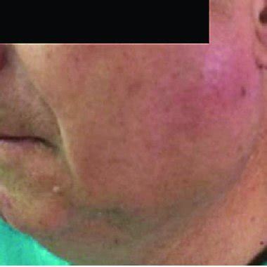 The Initial appearance of a patient with Mikulicz's Syndrome-facial ...