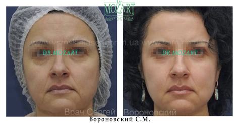 Лазерная дерматология - фото до и после лечения в Одессе и Украине