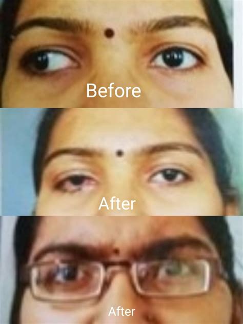 Squint Treatment (Exotropia) | Neo Eye Clinic