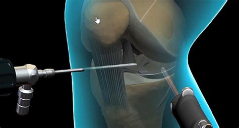 Knee Arthroscopy - Mediheal Group of Hospitals