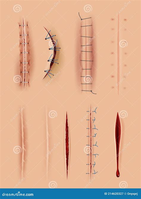 Method Of Surgical Suture For Wound Isolated On White Background Vector