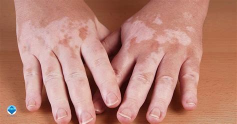 Vitiligo: Understanding the Symptoms and Causes - Skin Matters Bristol