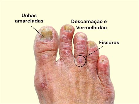 Doença Causada Por Fungo - Doencas Causadas Por Fungos Em Plantas 7 Doenças Fúngicas Que