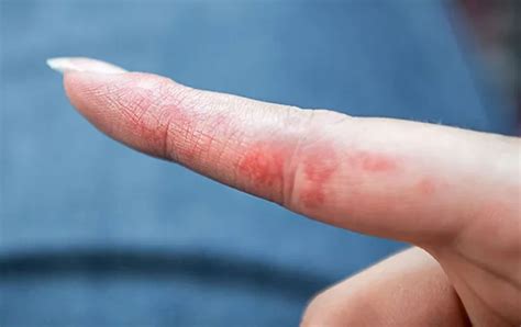 Stress Bumps on Fingers: How Do You Get Rid of Them? - Vivacity Asia ...