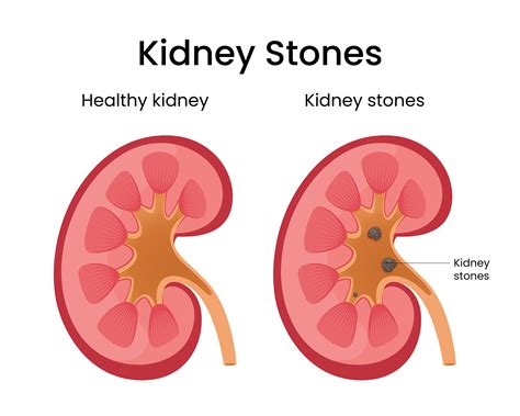 Kidney Stone Treatment | Expert Care & Information | CLS Health