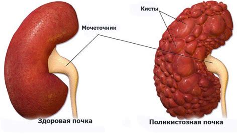 Киста почек у мужчин: лечение кисты на почках