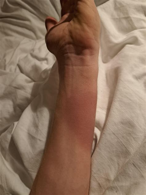 Swollen radius : r/medical_advice